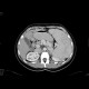 Congenital liver fibrosis, portal hypertension, porto-venous shunts: CT - Computed tomography